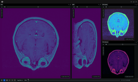 Screenshot of the Rerun viewer demoing the Dicom MRI example