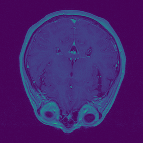 Screenshot of the Rerun viewer demoing the Dicom MRI example